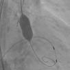 バルーンでの拡張中の大動脈弁の写真