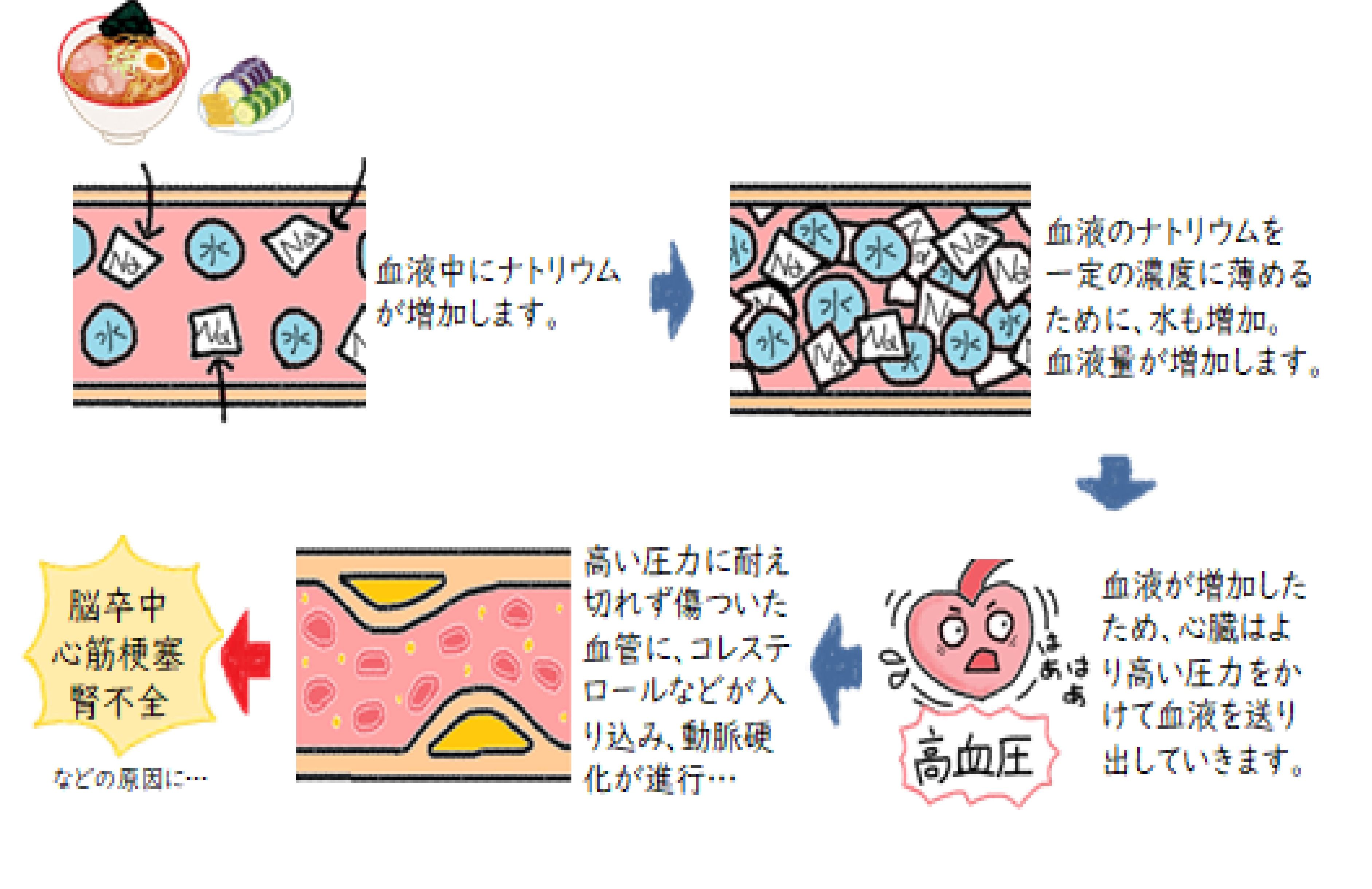 高血圧